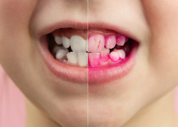 Plaque disclosing tablets in work. Before and after - effect. close up photo of young boy tooth. Dental plaque pill concept.